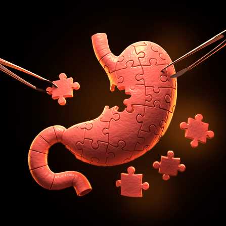 Redo bariatric surgeries Redo bariatric surgeries
